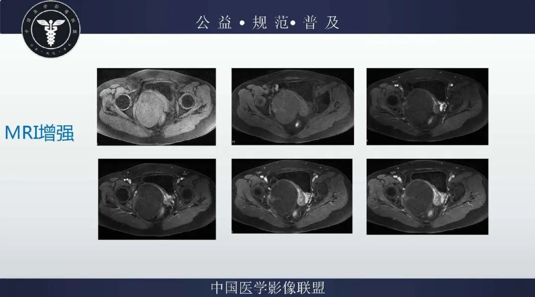 【病例】盆腔皮样囊肿1例MR影像