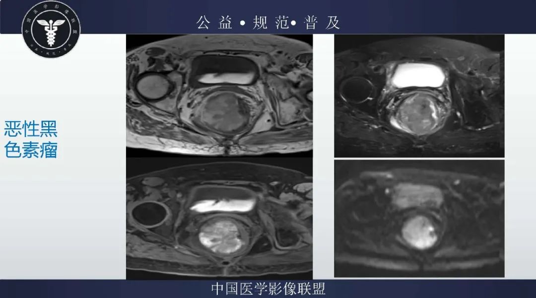 【病例】盆腔皮样囊肿1例MR影像