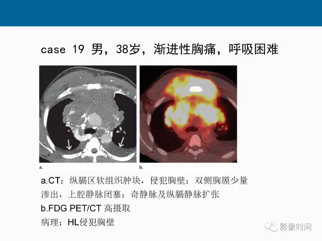 【PPT】胸壁恶性肿瘤的影像学评估