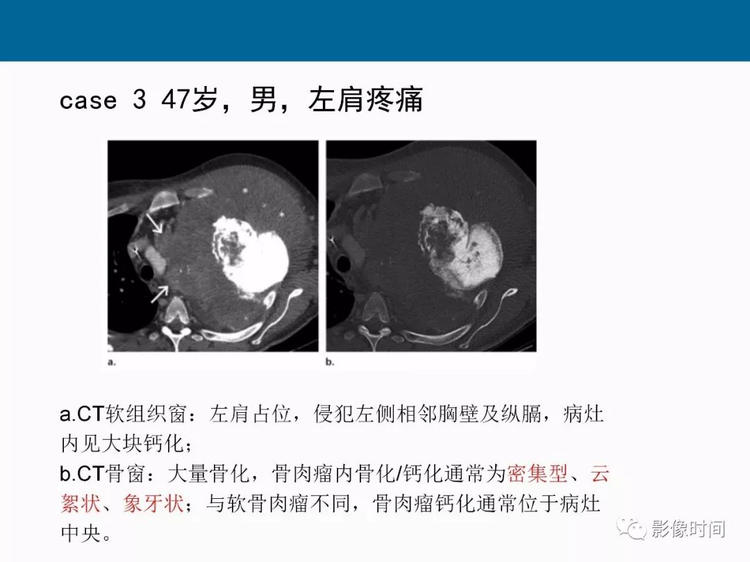 【PPT】胸壁恶性肿瘤的影像学评估