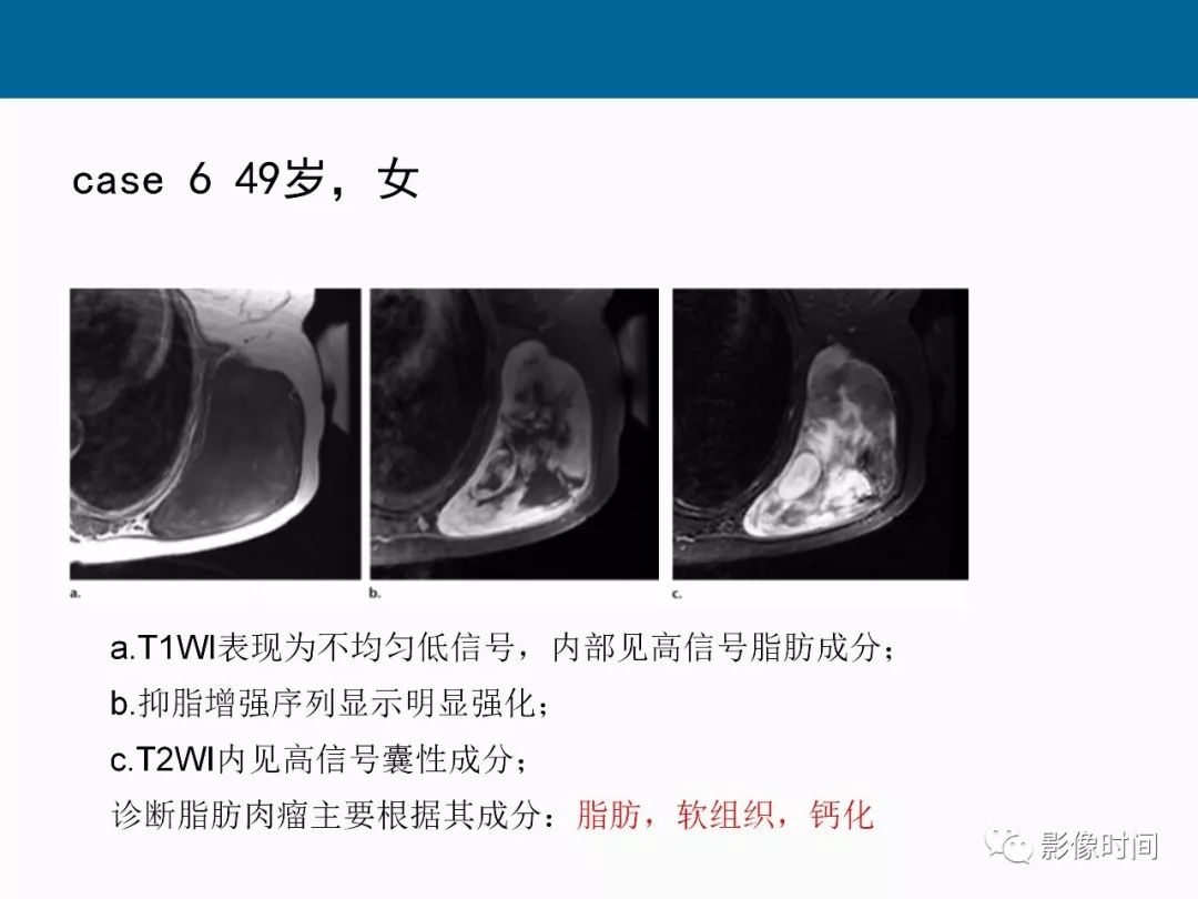 【PPT】胸壁恶性肿瘤的影像学评估