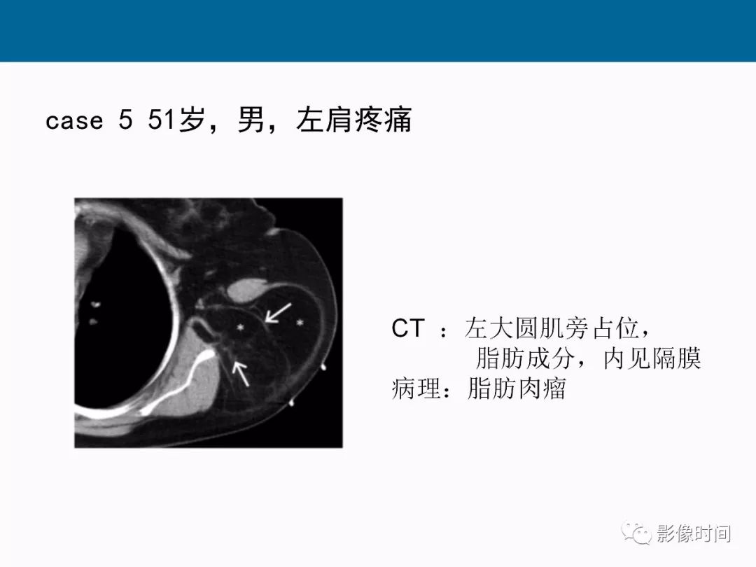 【PPT】胸壁恶性肿瘤的影像学评估