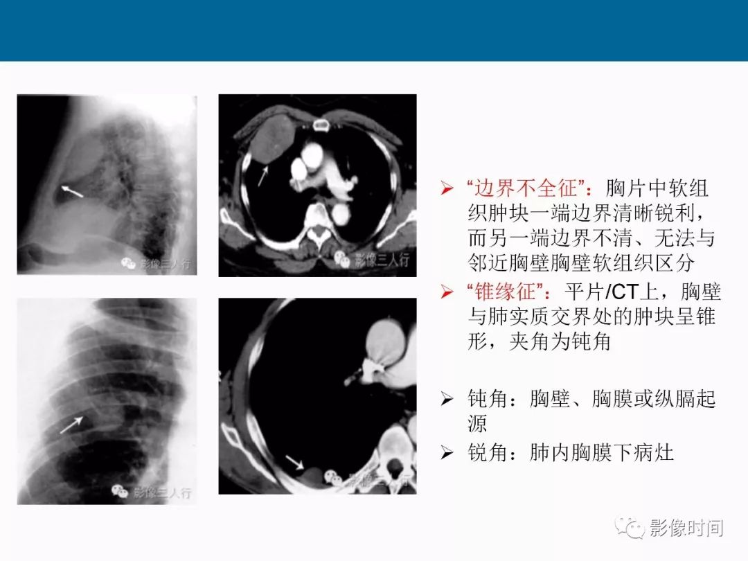 【PPT】胸壁恶性肿瘤的影像学评估
