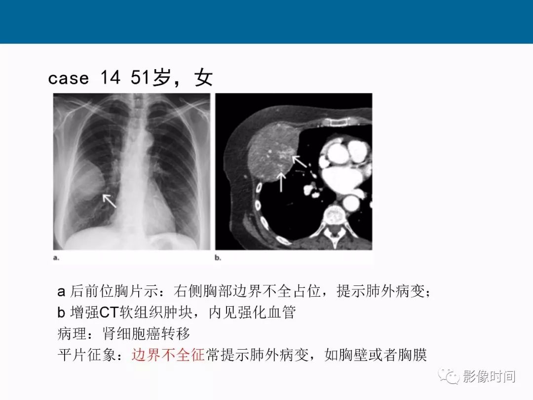 【PPT】胸壁恶性肿瘤的影像学评估