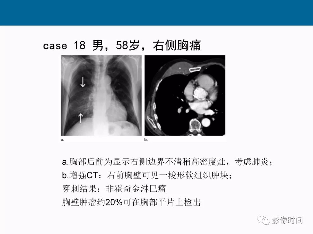 【PPT】胸壁恶性肿瘤的影像学评估