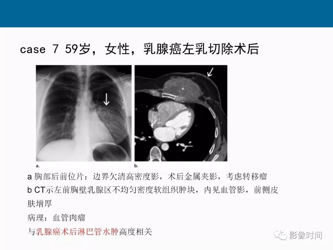 【PPT】胸壁恶性肿瘤的影像学评估