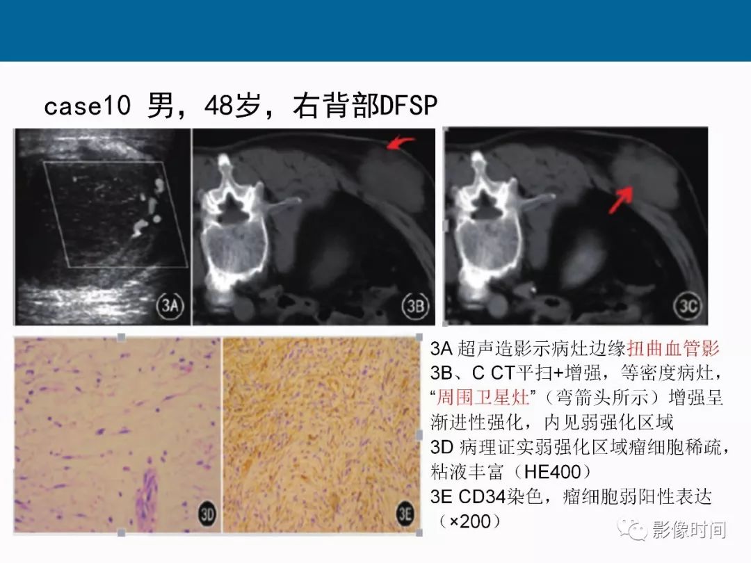 【PPT】胸壁恶性肿瘤的影像学评估