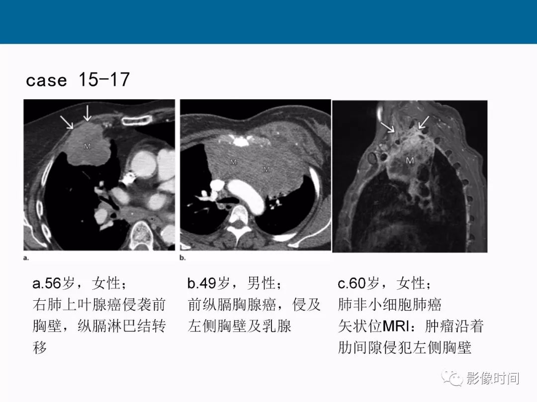 【PPT】胸壁恶性肿瘤的影像学评估