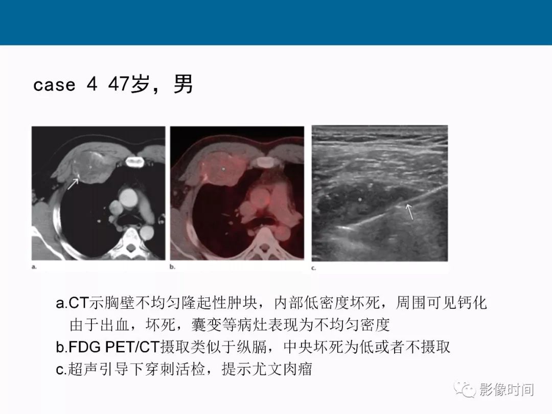 【PPT】胸壁恶性肿瘤的影像学评估