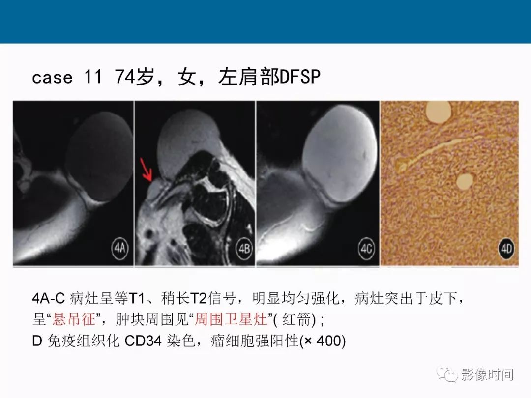 【PPT】胸壁恶性肿瘤的影像学评估