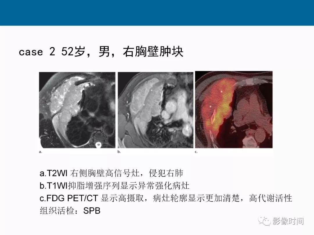 【PPT】胸壁恶性肿瘤的影像学评估
