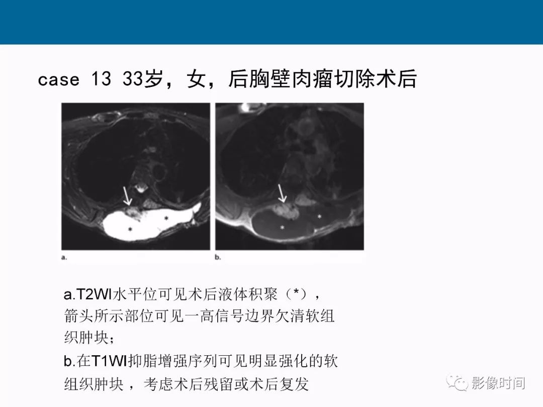 【PPT】胸壁恶性肿瘤的影像学评估