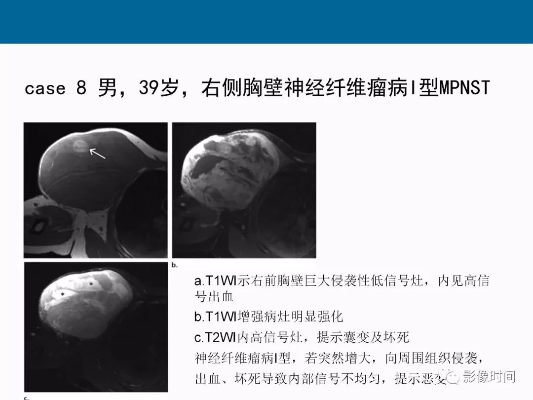 【PPT】胸壁恶性肿瘤的影像学评估