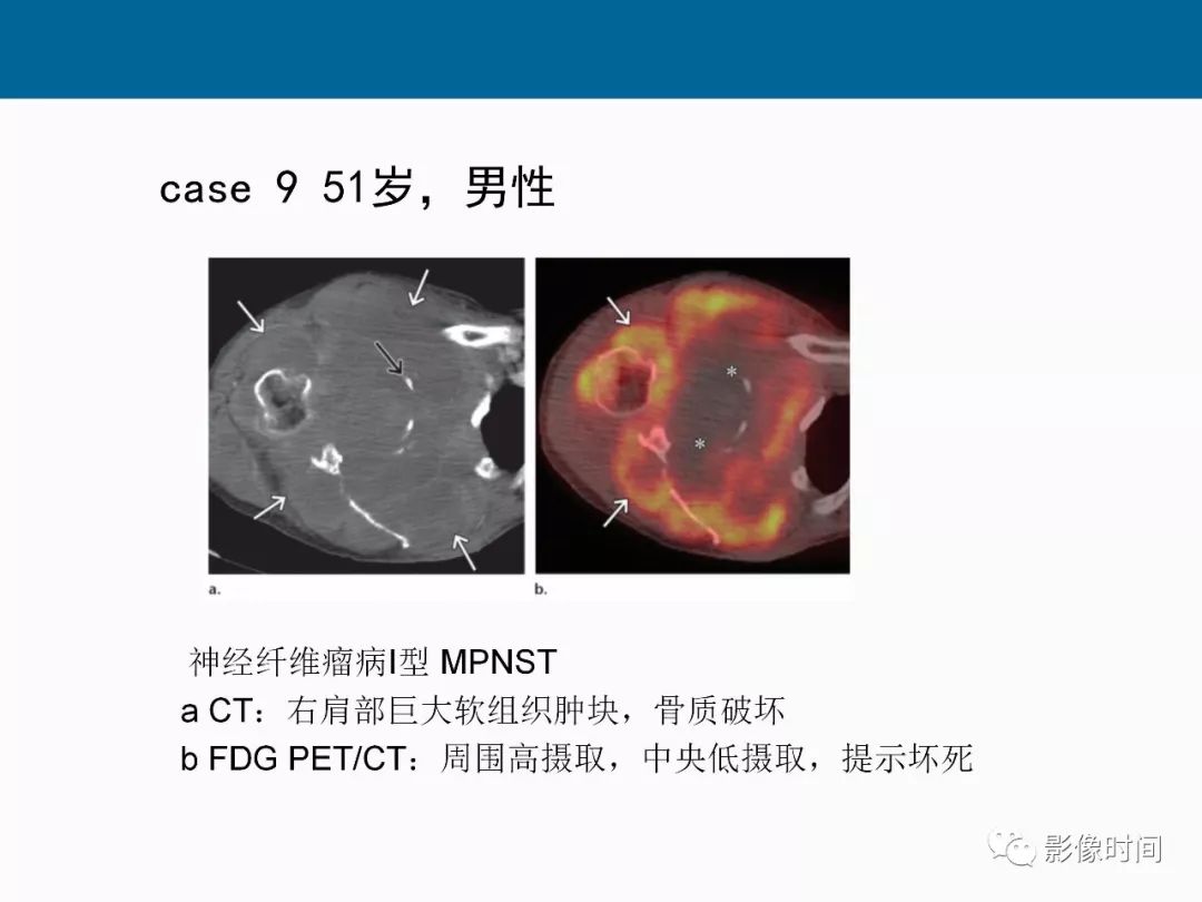 【PPT】胸壁恶性肿瘤的影像学评估