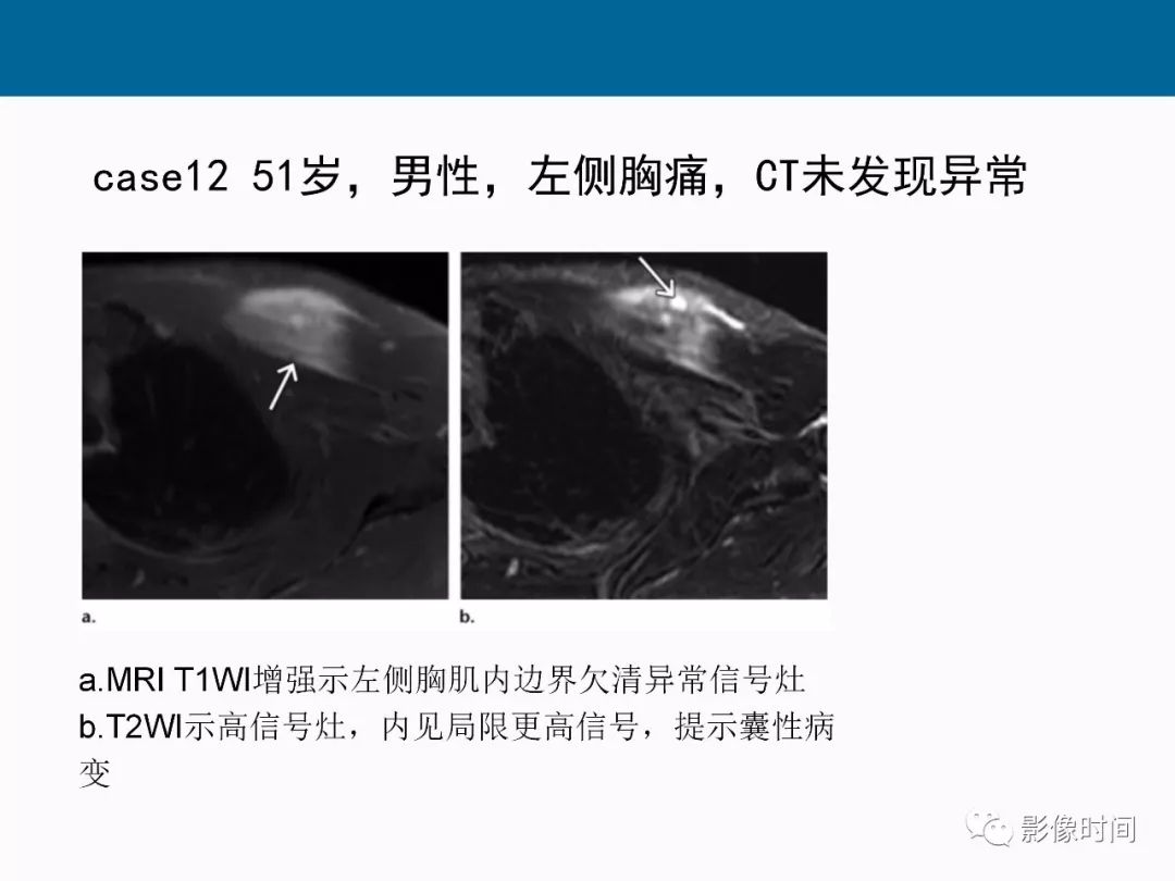 【PPT】胸壁恶性肿瘤的影像学评估