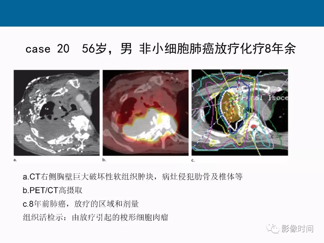 【PPT】胸壁恶性肿瘤的影像学评估