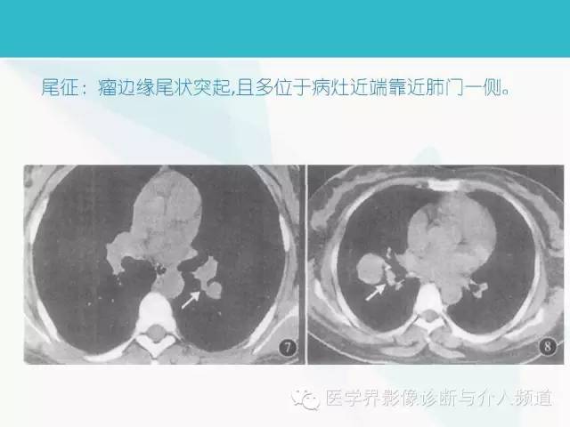 【PPT】肺良性肿瘤的影像学浅析
