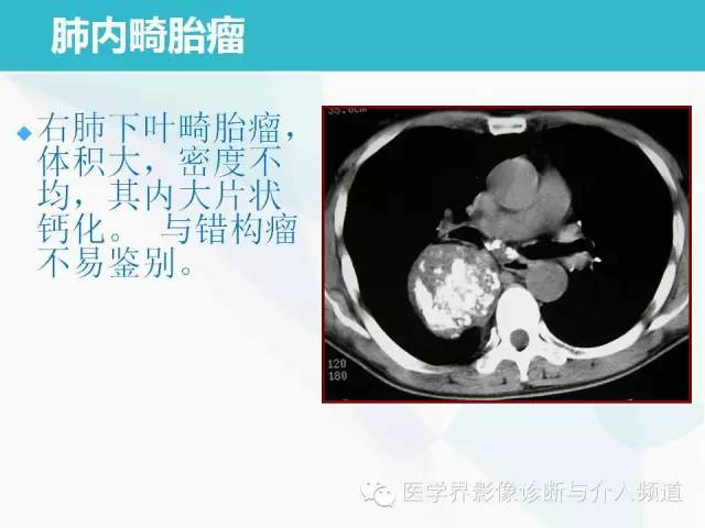 【PPT】肺良性肿瘤的影像学浅析