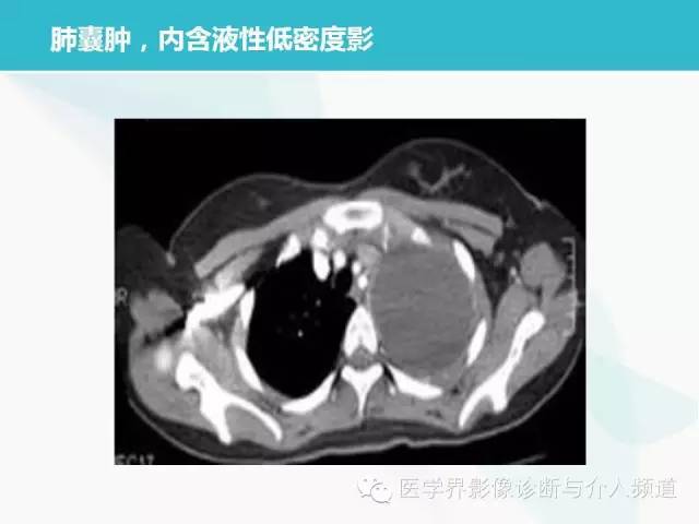 【PPT】肺良性肿瘤的影像学浅析
