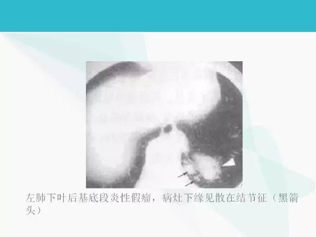 【PPT】肺良性肿瘤的影像学浅析