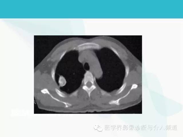 【PPT】肺良性肿瘤的影像学浅析