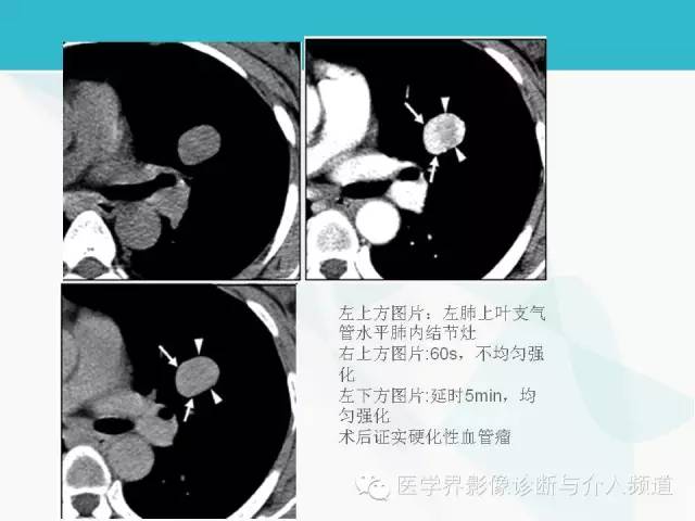 【PPT】肺良性肿瘤的影像学浅析