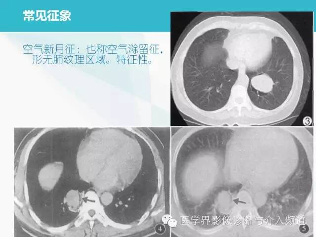 【PPT】肺良性肿瘤的影像学浅析