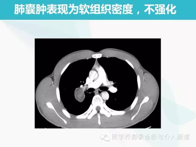 【PPT】肺良性肿瘤的影像学浅析