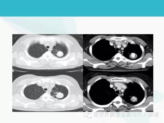 【PPT】肺良性肿瘤的影像学浅析