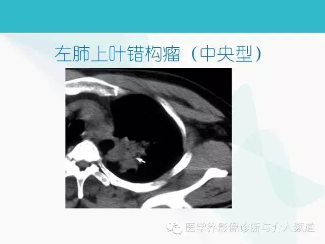 【PPT】肺良性肿瘤的影像学浅析