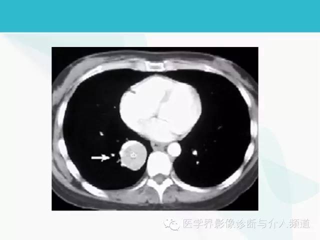 【PPT】肺良性肿瘤的影像学浅析