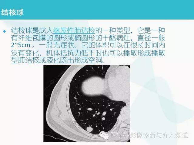 【PPT】肺良性肿瘤的影像学浅析