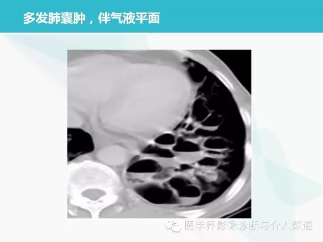 【PPT】肺良性肿瘤的影像学浅析