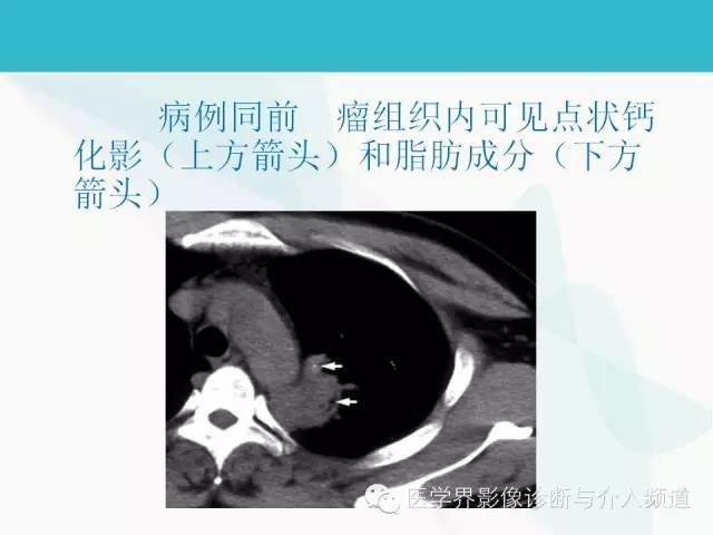 【PPT】肺良性肿瘤的影像学浅析