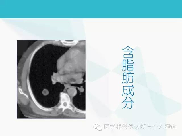 【PPT】肺良性肿瘤的影像学浅析