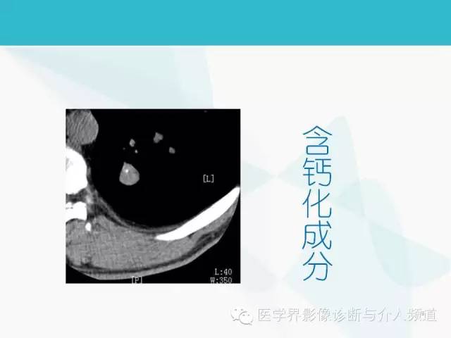 【PPT】肺良性肿瘤的影像学浅析