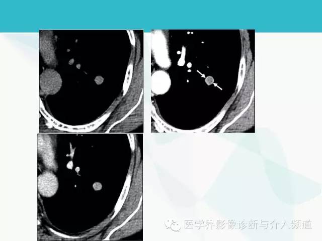 【PPT】肺良性肿瘤的影像学浅析