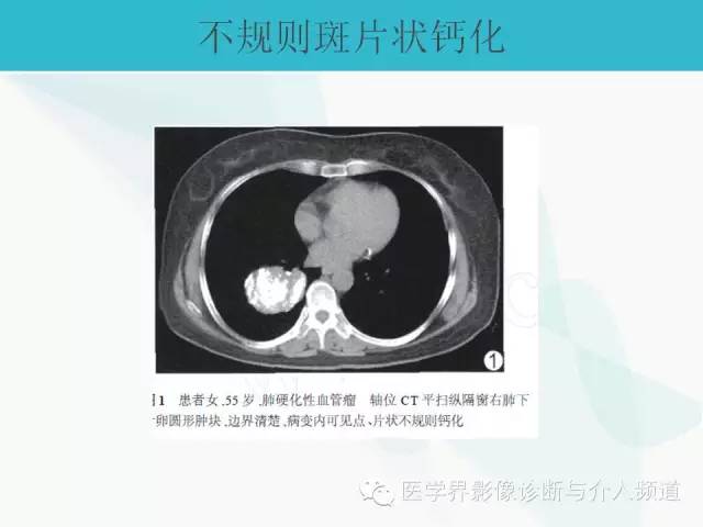 【PPT】肺良性肿瘤的影像学浅析
