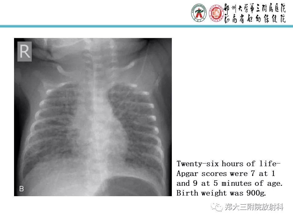 【PPT】间质性肺气肿的影像诊断