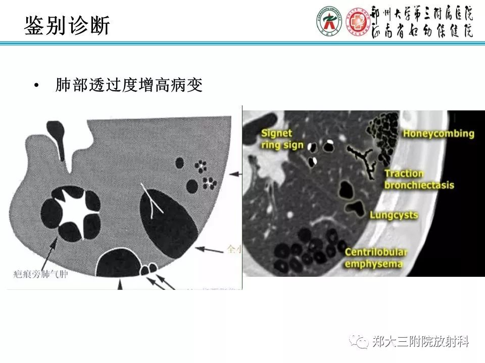【PPT】间质性肺气肿的影像诊断