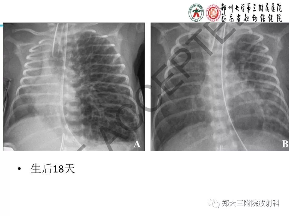 【PPT】间质性肺气肿的影像诊断