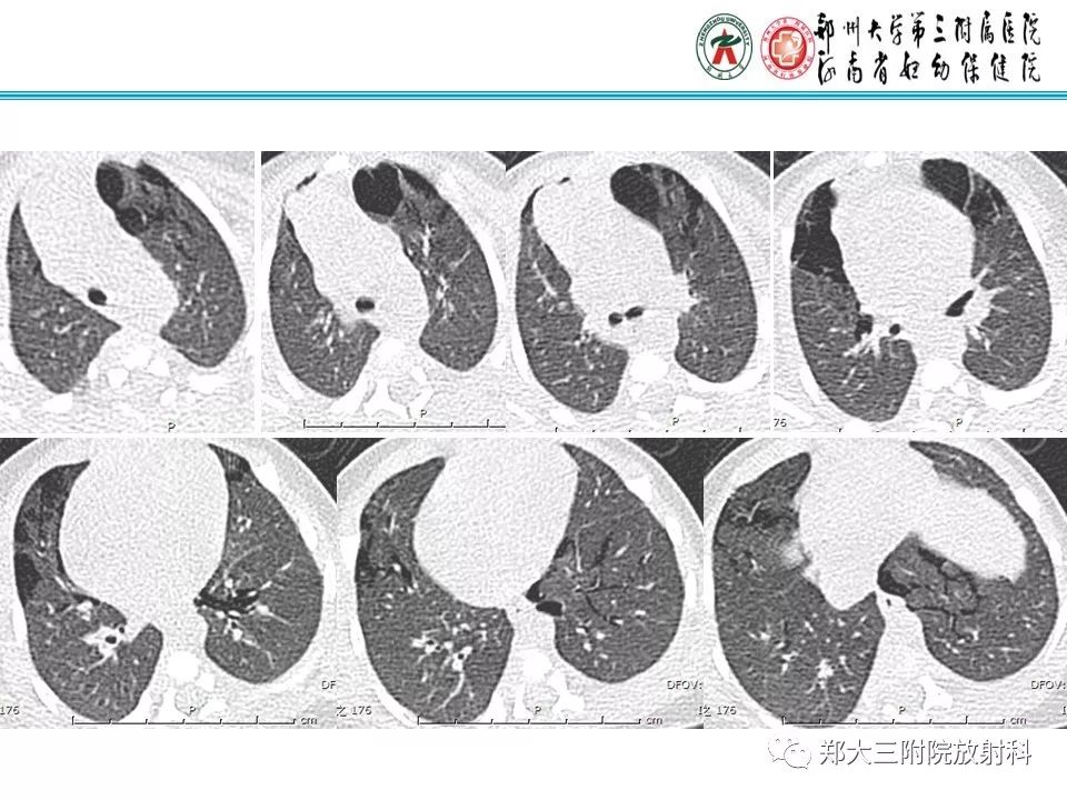 【PPT】间质性肺气肿的影像诊断