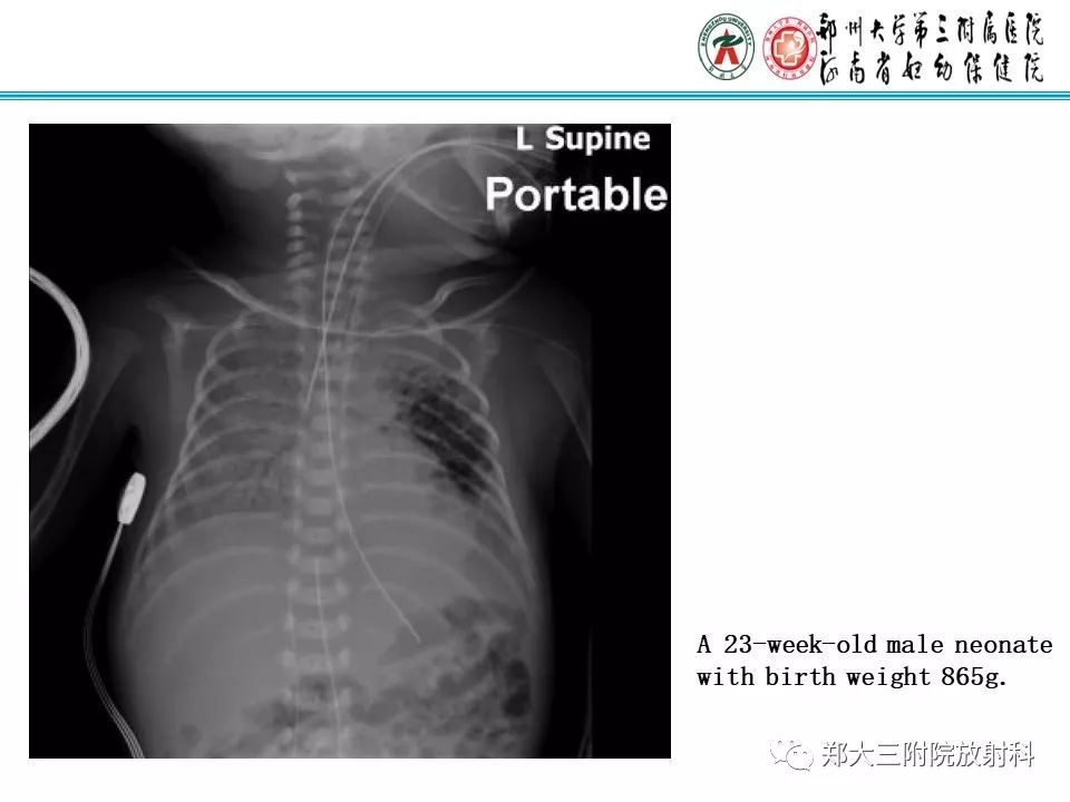 【PPT】间质性肺气肿的影像诊断