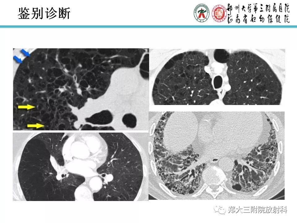 【PPT】间质性肺气肿的影像诊断