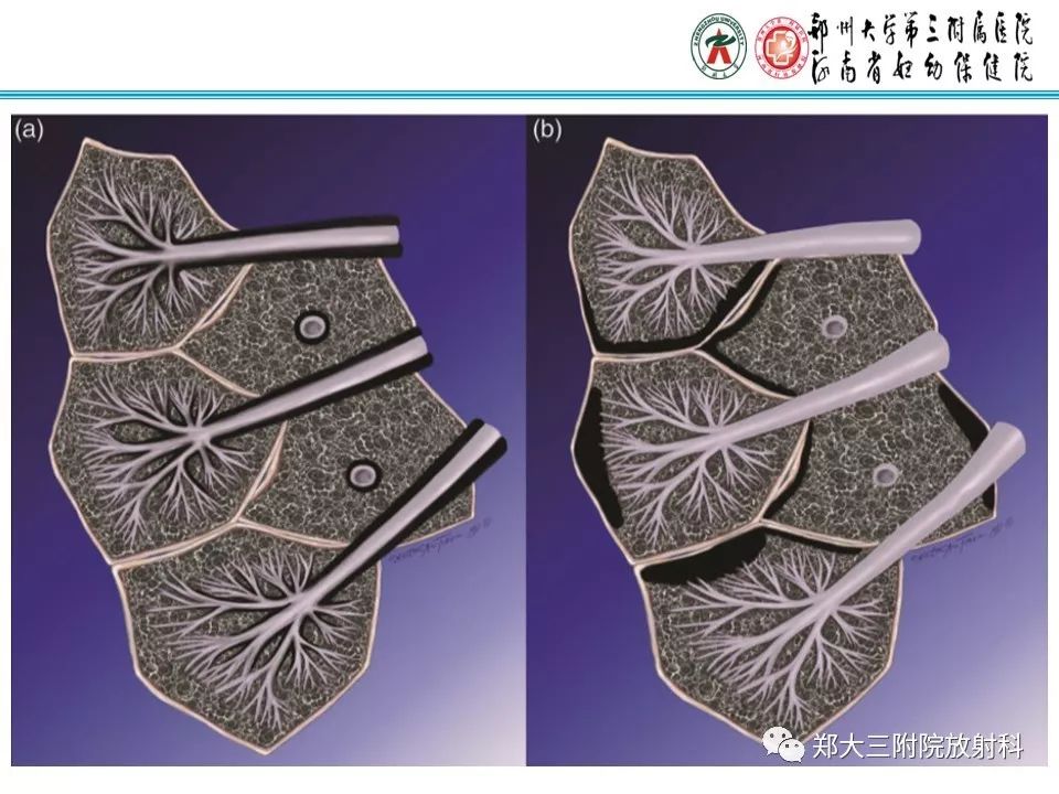 【PPT】间质性肺气肿的影像诊断