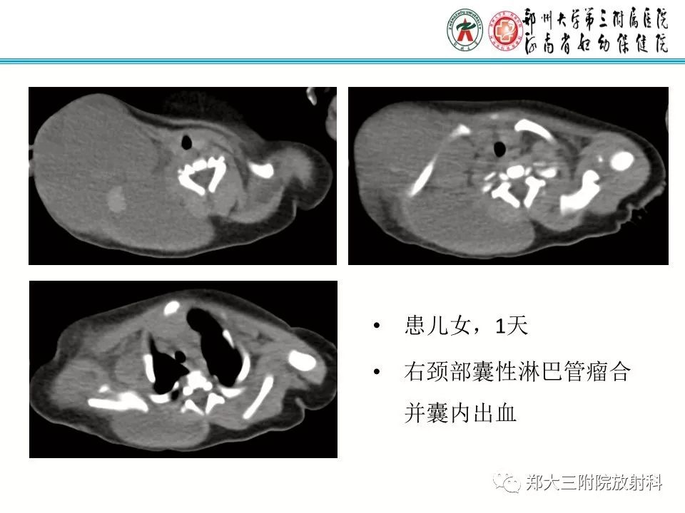 【PPT】间质性肺气肿的影像诊断