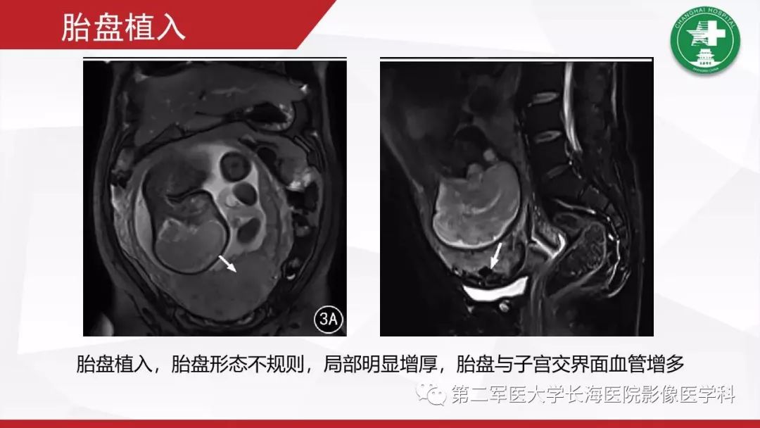 【PPT】胎盘植入的MRI征象