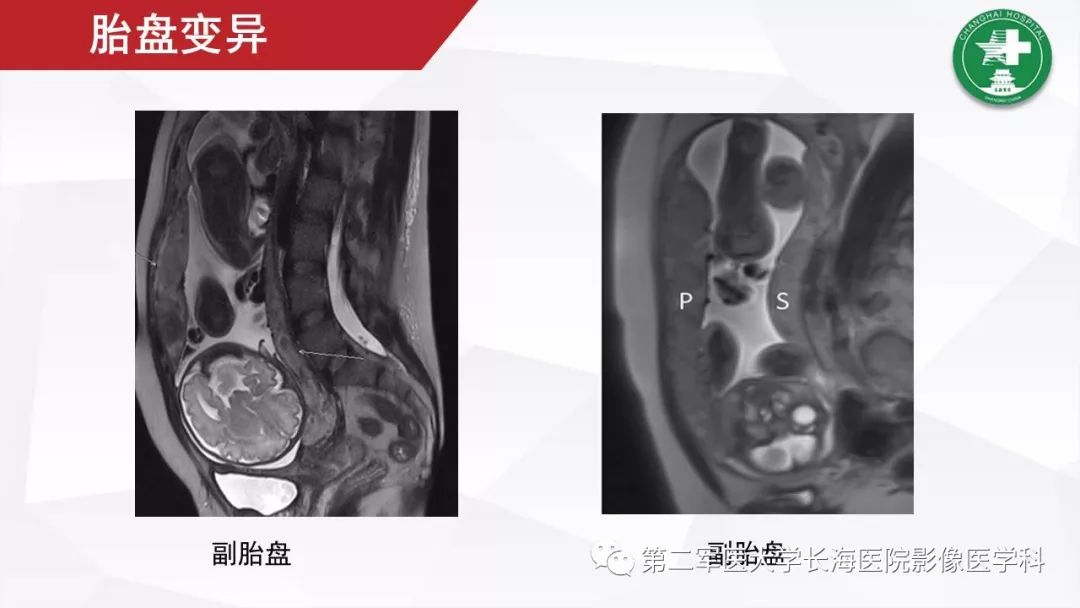 【PPT】胎盘植入的MRI征象