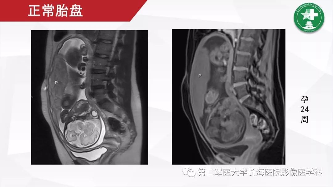 【PPT】胎盘植入的MRI征象