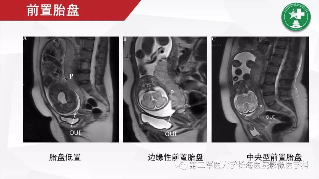 【PPT】胎盘植入的MRI征象